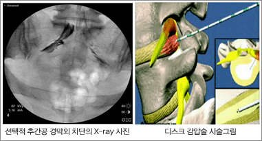 [왼쪽] 선택적 추간공 경막외 차단의 x-ray 사진, [오른쪽] 디스크 감압술 시술그림