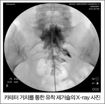 카테터 거ㅣ를 통한 유착 제거술의 x-ray 사진