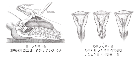 [왼쪽] 골반내시경수술, 개복하지 않고 내시경을 삽입하여 수술, [오른쪽] 자궁내시경수술, 자궁안에 내시경을 삽입하여 이상조직을 제거하는 수술