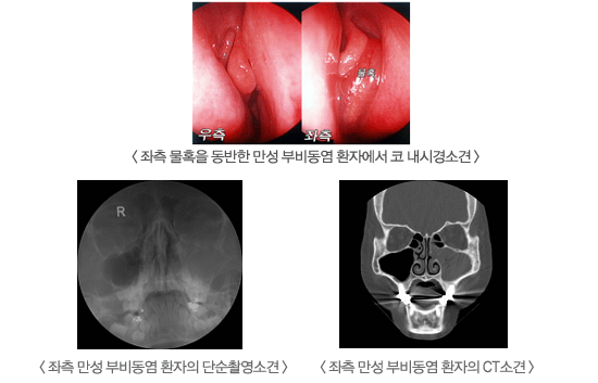 [위] 좌측 물혹을 동반한 만성부비동염 환자에서 코 내시경소견, [아래] 좌측 만성부비동염 환자
