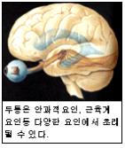 µÎÅëÀº ¾È°úÀû ¿äÀÎ, ±ÙÀ°°è ¿äÀÎ µî ´Ù¾çÇÑ ¿äÀο¡¼ ÃÊ·¡µÉ¼ö ÀÖ´Ù.