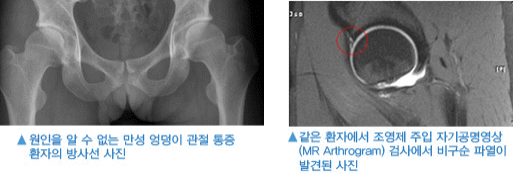 좌: 원인을 알수없는 만성 엉덩이 관절 통증 환자의 방사선 사진, 우: 조영제 주입 자기공명영상 검사에서 비구순 파열이 발견된 사진