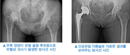 좌: 우측 엉덩이 관절 골절 후유증으로 무혈성 괴사가 발생한 방사선 사진, 우: 인공관절 치환술로 치료한 결과를 보여주는 방사선 사진