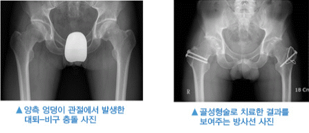 좌: 양측 엉덩이 관절에서 발생한 대퇴-비구 충돌 사진, 우: 골성형술로 치료한 결과를 보여주는 방사선 사진