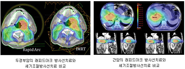 좌: 두경부암의 래피드아크 방사선치료와 세기조절방사선치료 비교 사진, 우: 간암의 래피드아크 방사선치료와 세기조절방사선치료 비교 사진