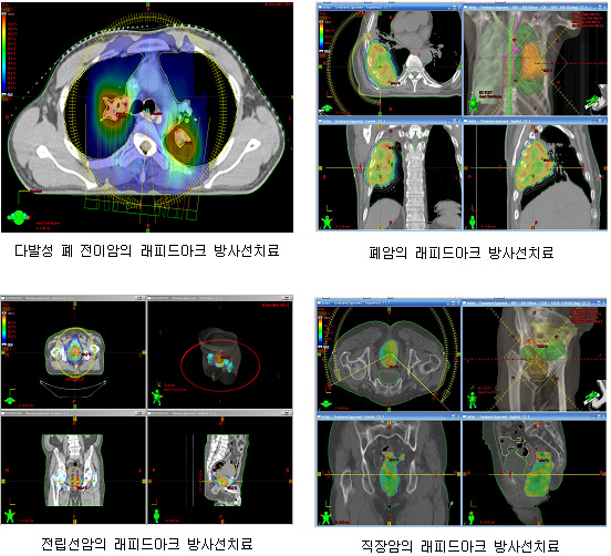 상단왼쪽: 다발성 폐 전이암의 래피드아크 방사선치료 사진, 상단오른쪽: 폐암의 래피드아크 방사선치료 사진, 하단왼쪽: 전립선암의 래피드아크 방사선치료 사진, 하단오른쪽: 직장암의 래피드아크 방사선치료 사진