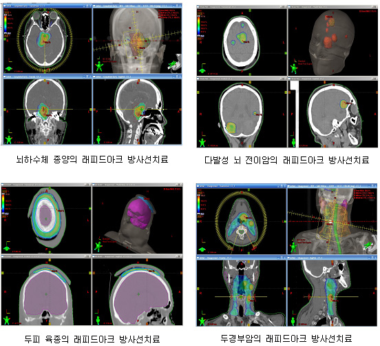 상단왼쪽: 뇌하수체 종양의 래피드아크 방사선치료 사진, 상단오른쪽: 다발성 뇌 전이암의 래피드아크 방사선치료 사진, 하단왼쪽: 두피 육종의 래피드아크 방사선치료 사진, 하단오른쪽: 두경부암의 래피드아크 방사선치료 사진