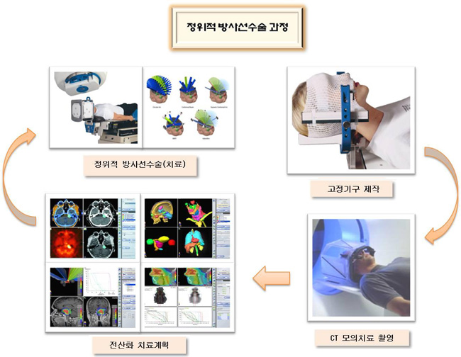 정위적 방사선수술 과정은 고정기구 제작 후 CT 모의치료촬영, 전산화치료계획, 정위적방사선수술 설명한 이미지