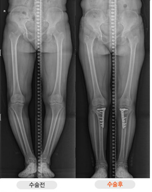 오다리교정수술 O자형 휜 다리에 3